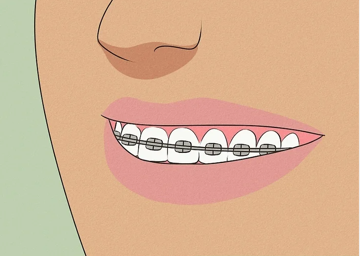 3. Embrace Your Braces